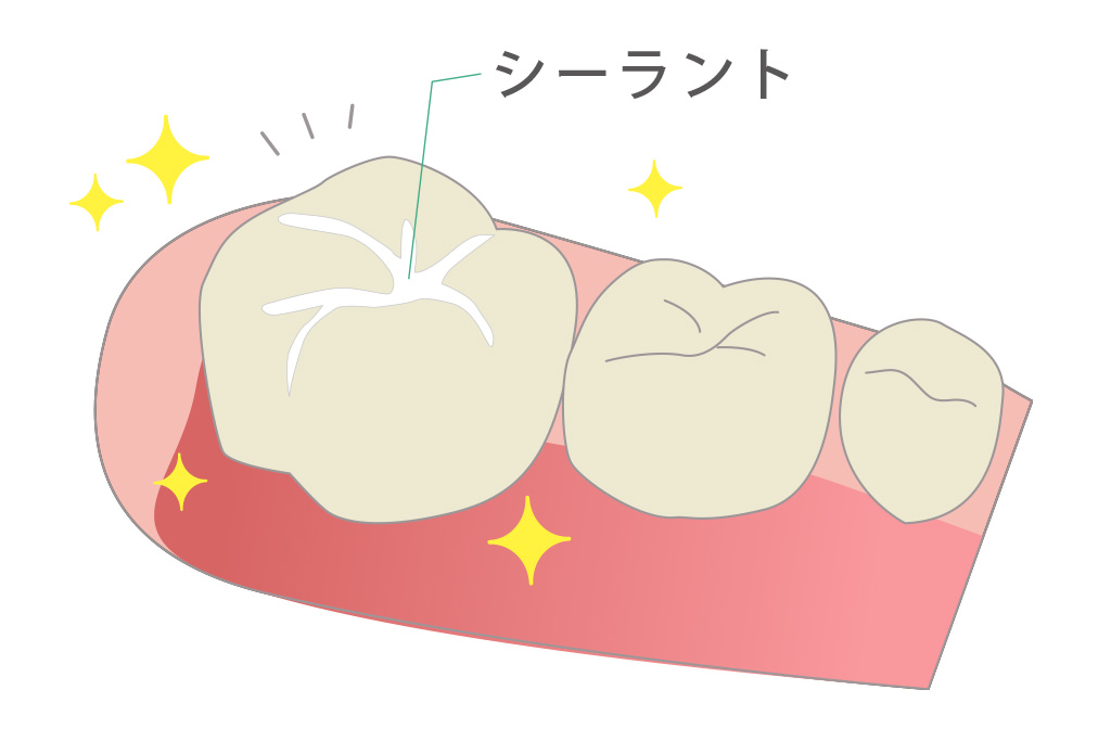 シーラント